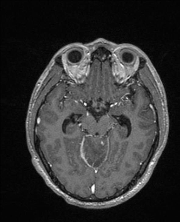 Cerebral toxoplasmosis (Radiopaedia 85779-101597 Axial T1 C+ 67).jpg