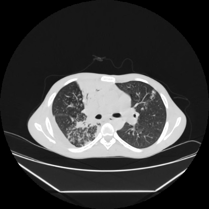 Cerebral tuberculoma (Radiopaedia 80829-94318 Axial lung window 71).jpg