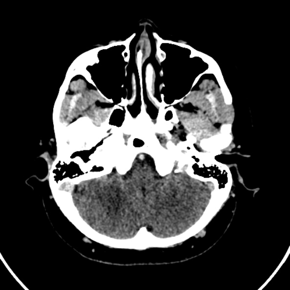 Cerebral venous hemorrhagic infarct from venous sinus thrombosis (Radiopaedia 55433-61883 Axial C+ delayed 122).jpg