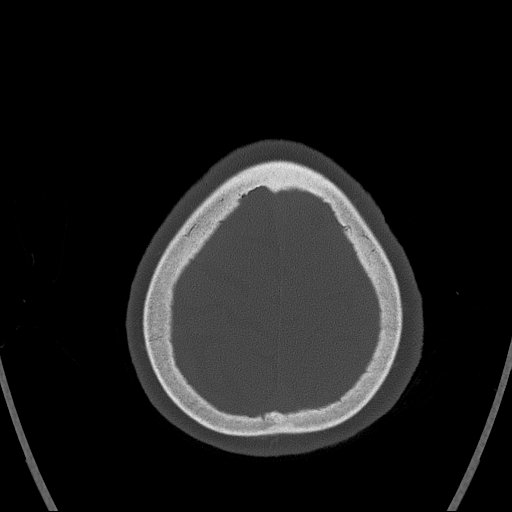 Cerebral venous infarction with hemorrhage (Radiopaedia 65343-74381 Axial bone window 170).jpg