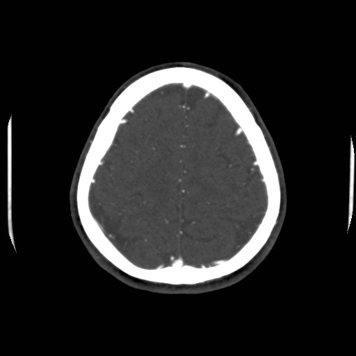 Cerebral venous sinus thrombosis (Radiopaedia 40619-43227 A 190).jpg