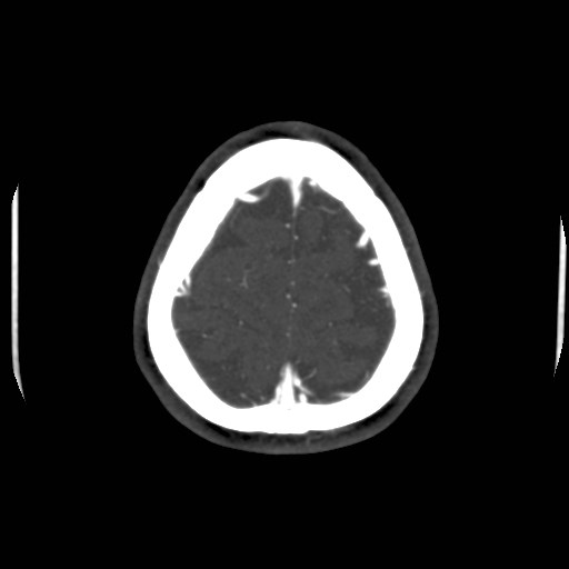 Cerebral venous sinus thrombosis (Radiopaedia 40619-43227 A 204).jpg