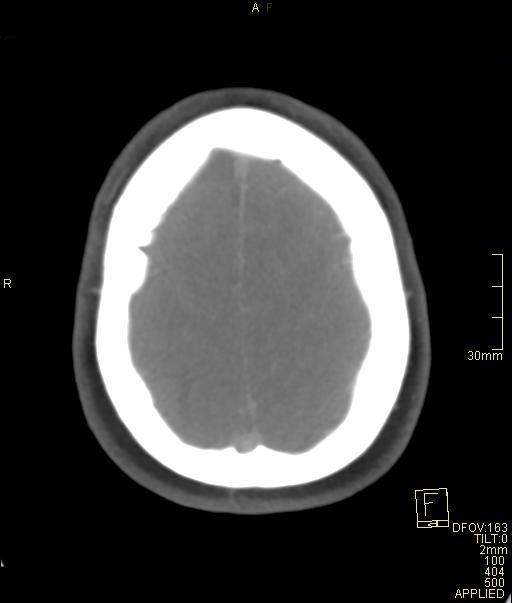 Cerebral venous sinus thrombosis (Radiopaedia 91329-108965 Axial venogram 69).jpg
