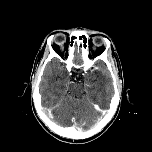File:Cerebral venous thrombosis (CVT) (Radiopaedia 77524-89685 Axial with contrast 14).jpg