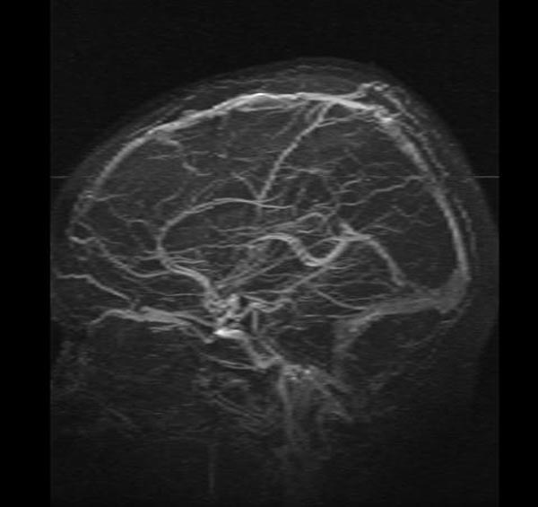 File:Cerebral venous thrombosis (Radiopaedia 11289-11653 None 4).jpg
