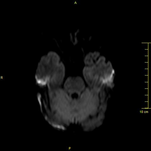 File:Cerebral venous thrombosis (Radiopaedia 23288-23351 Axial DWI 11).JPG