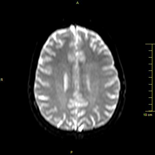 File:Cerebral venous thrombosis (Radiopaedia 23288-23351 Axial DWI 28).JPG