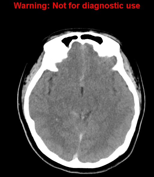 File:Cerebral venous thrombosis (Radiopaedia 37224-38992 Axial non-contrast 13).jpg