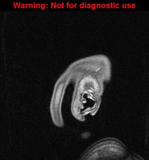 File:Cerebral venous thrombosis (Radiopaedia 37224-39208 Sagittal T1 C+ 1).jpg