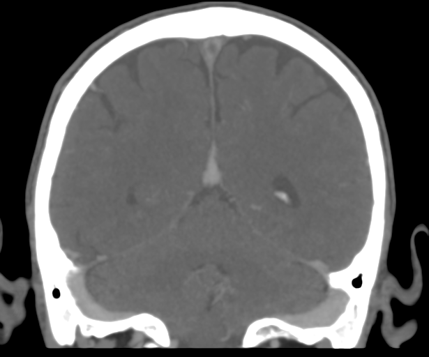 Cerebral venous thrombosis (Radiopaedia 38392-40467 Coronal CTA-Venogram 44).png