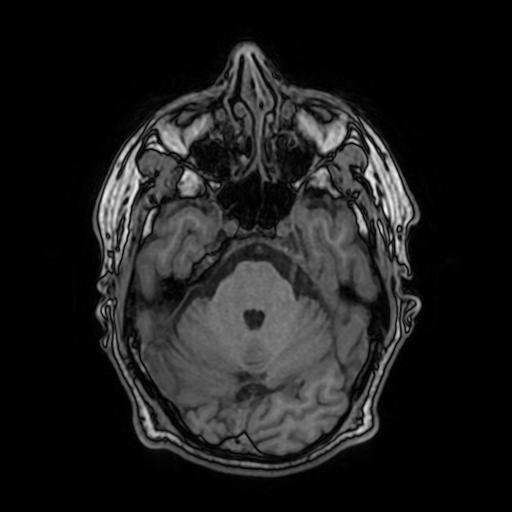 File:Cerebral venous thrombosis with secondary intracranial hypertension (Radiopaedia 89842-106957 Axial T1 62).jpg