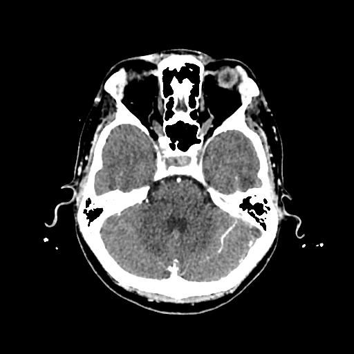 Cerebral venous thrombosis with venous hemorrhagic infarct (Radiopaedia 90354-107660 Axial with contrast 51).jpg