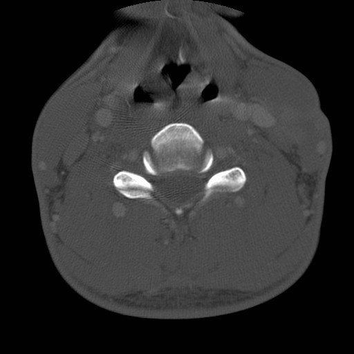 Cervical Pott disease (Radiopaedia 20374-20286 Axial bone window 90).jpg