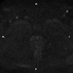 Cervical adenocarcinoma (Radiopaedia 65011-73985 Axial DWI 11).jpg