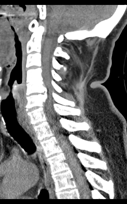 Cervical canal stenosis - OPLL and osteophytes (Radiopaedia 47329-51910 B 41).png