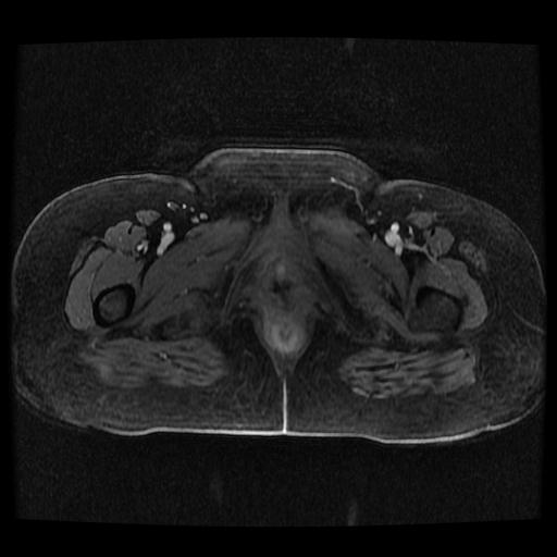 Cervical carcinoma (Radiopaedia 70924-81132 Axial T1 C+ fat sat 108).jpg