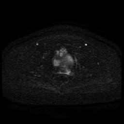 Cervical carcinoma (Radiopaedia 85405-101028 Axial DWI 47).jpg