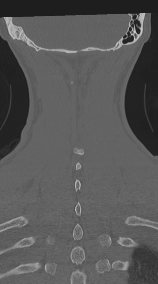Cervical intercalary bone (Radiopaedia 35211-36748 Coronal bone window 65).png