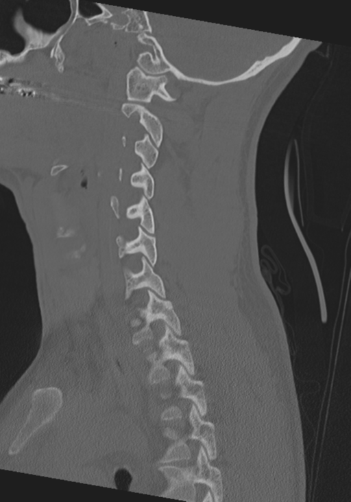 Cervical intercalary bone (Radiopaedia 35211-36748 Sagittal bone window 29).png