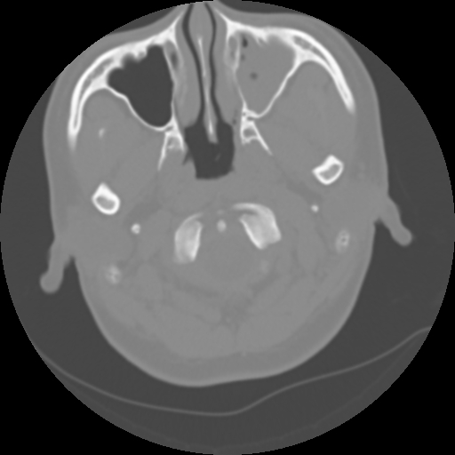 Cervical rib (Radiopaedia 71110-81363 Axial non-contrast 14).jpg