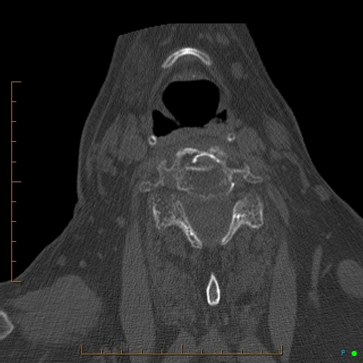 Cervical spine fracture - ankylosing spondylitis (Radiopaedia 76835-88706 Axial bone window 135).jpg