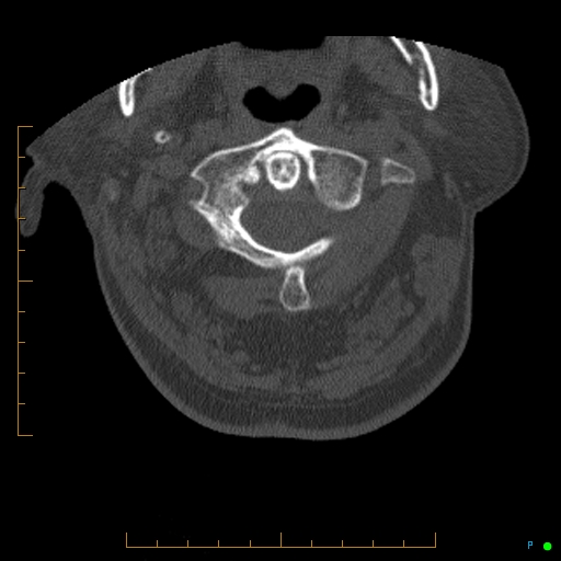 Cervical spine fracture - ankylosing spondylitis (Radiopaedia 76835-88706 Axial bone window 33).jpg