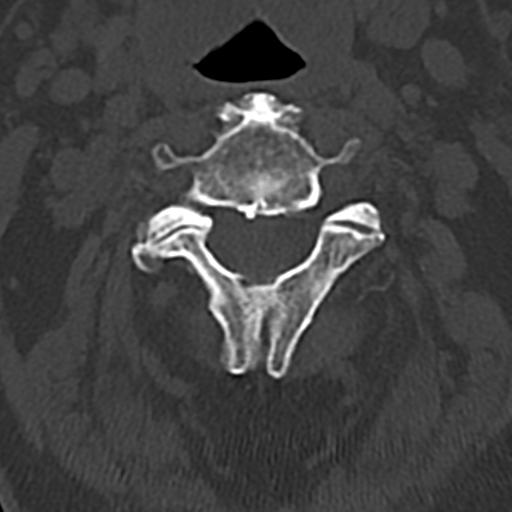File:Cervical spine fracture - chalk stick (Radiopaedia 39116-41323 Axial bone window 30).png