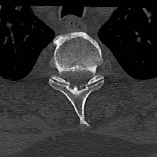 File:Cervical spine fracture - chalk stick (Radiopaedia 39116-41323 Axial bone window 98).png