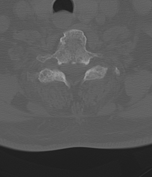 Cervical spine fracture in the setting of ankylosis (Radiopaedia 37038-38715 Axial bone window 47).png