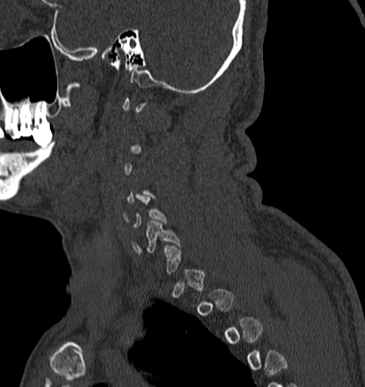 Cervical spine trauma with tear drop fracture and perched facet joint (Radiopaedia 53989-60127 Sagittal bone window 14).jpg