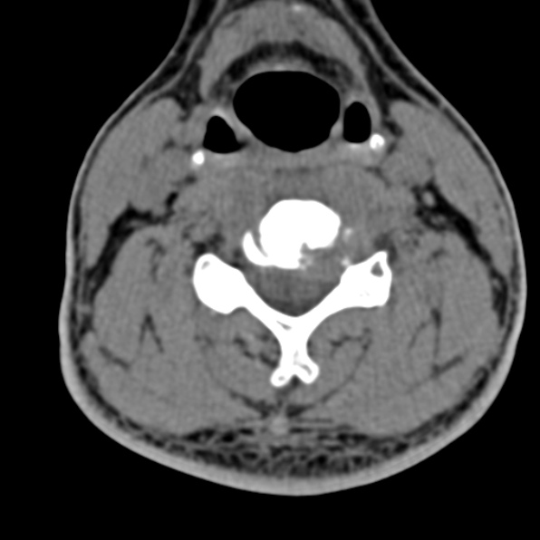 File:Cervical spondylodiscitis (Radiopaedia 28057-29489 Axial non-contrast 43).jpg