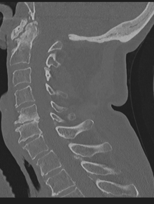 Cervical spondylolysis (Radiopaedia 49616-54811 Sagittal bone window 39).png