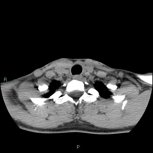Cervical thymic cyst (Radiopaedia 88632-105335 Axial non-contrast 35).jpg