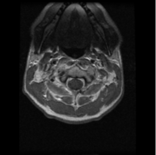 File:Cervical vertebrae metastasis (Radiopaedia 78814-91667 Axial T1 C+ 21).png