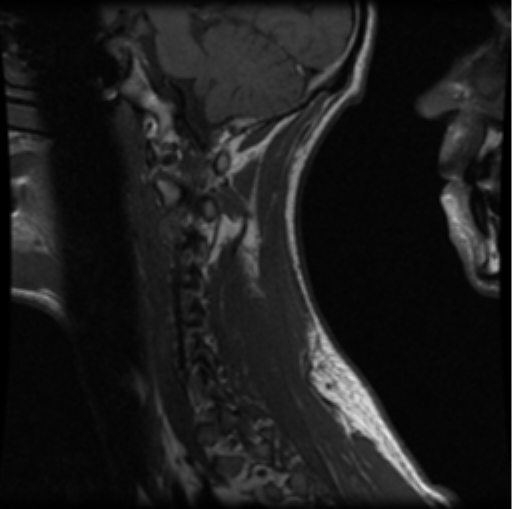 File:Cervical vertebrae metastasis (Radiopaedia 78814-91667 Sagittal T1 3).png