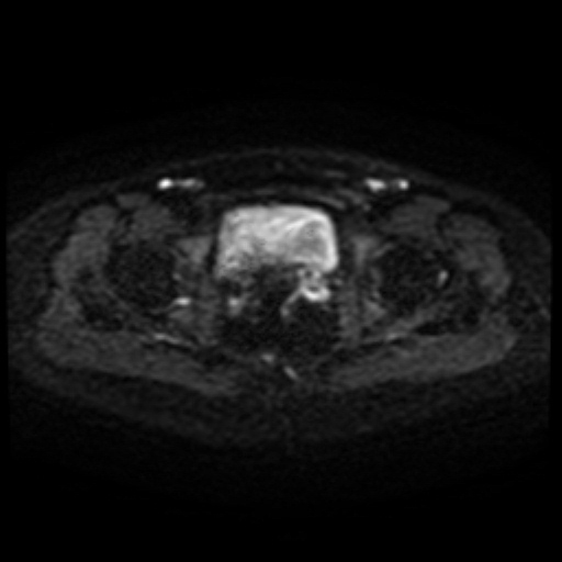 File:Cesarian section scar endometriosis (Radiopaedia 66520-75799 Axial DWI 44).jpg