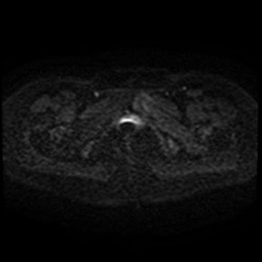 Cesarian section scar endometriosis (Radiopaedia 66520-75799 Axial DWI 74).jpg