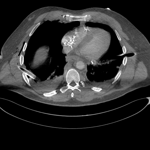 File:Chest multitrauma - aortic injury (Radiopaedia 34708-36147 A 199).png