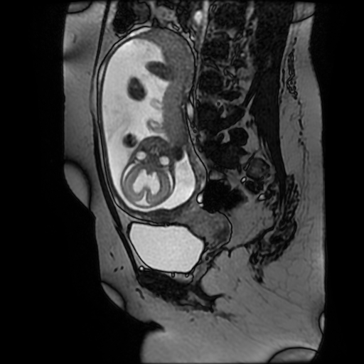 Chiari II malformation - fetal MRI (Radiopaedia 68099-77581 Sagittal Fiesta 25).jpg
