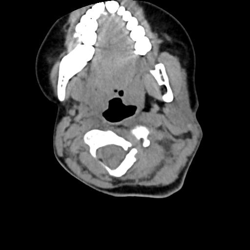 Chiari I with syrinx and skull base anomalies (Radiopaedia 89444-106412 Axial non-contrast 60).jpg