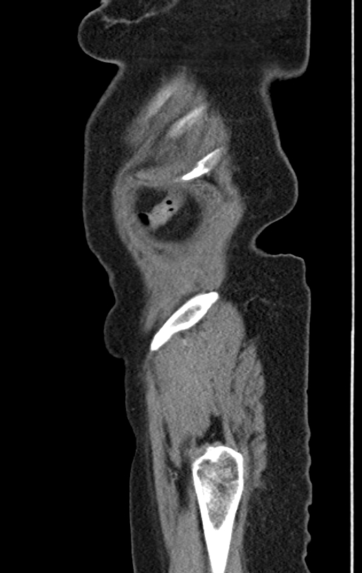Cholecystoduodenal fistula due to calculous cholecystitis with gallstone migration (Radiopaedia 86875-103077 C 3).jpg
