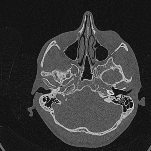 Cholesteatoma (Radiopaedia 70429-80529 Axial bone window 78).jpg