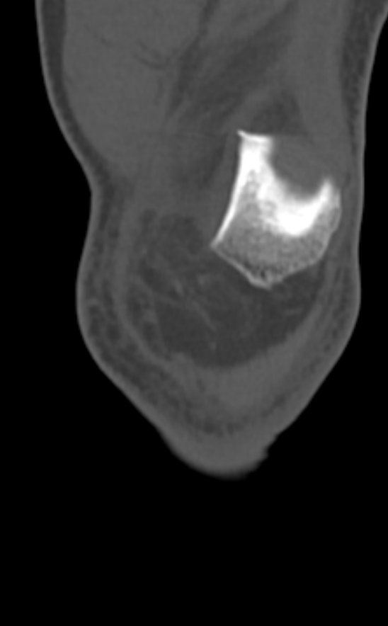 Chondrocalcinosis (Radiopaedia 82862-97173 Coronal bone window 16).jpg