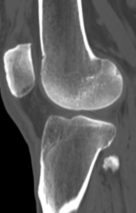 Chondrocalcinosis (Radiopaedia 82862-97173 Sagittal bone window 41).jpg