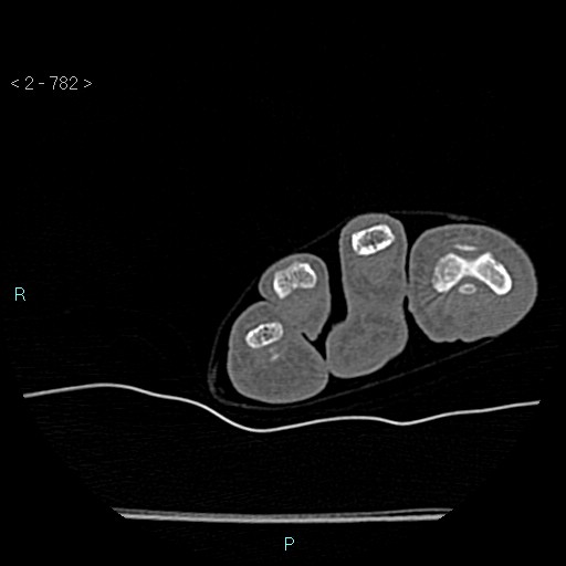 Chondrosarcoma - phalanx (Radiopaedia 69047-78812 Axial bone window 36).jpg