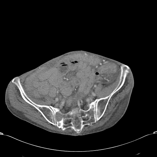 Chondrosarcoma of the spine (Radiopaedia 49871-55143 A 48).jpg