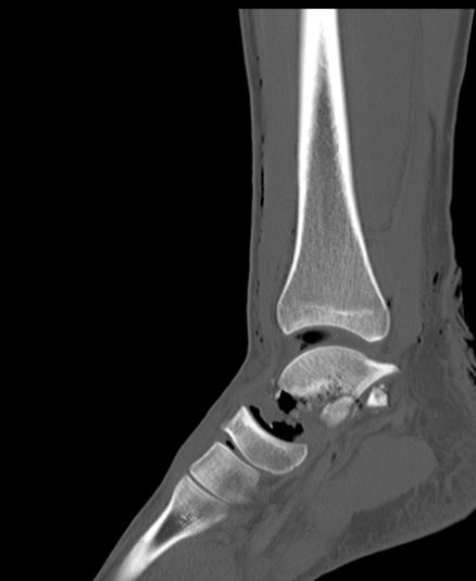 Chopart fracture (Radiopaedia 35347-36851 Sagittal bone window 33).jpg