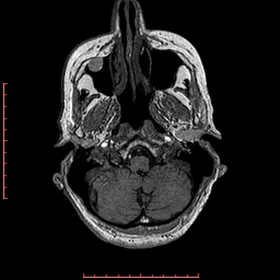File:Choroid plexus xanthogranuloma (Radiopaedia 67843-77270 Axial T1 138).jpg