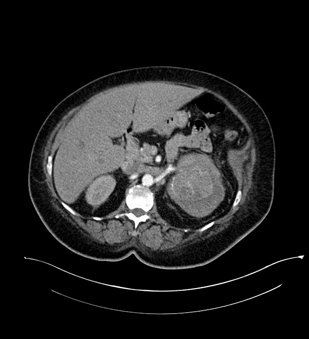Chromophobe renal cell carcinoma (Radiopaedia 84239-99519 B 41).jpg