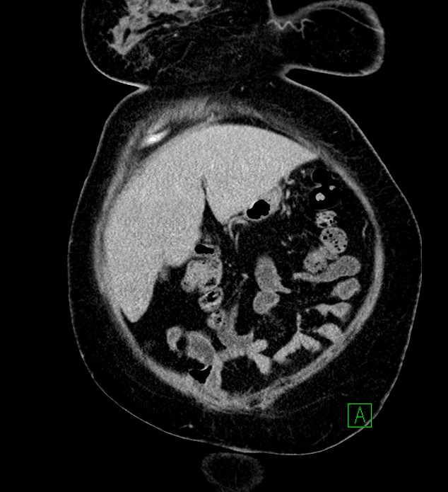 Chromophobe renal cell carcinoma (Radiopaedia 84239-99519 F 18).jpg